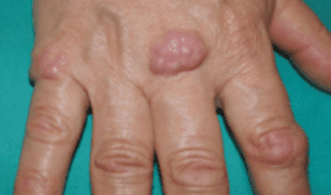 Granuloma Anular Subcutáneo