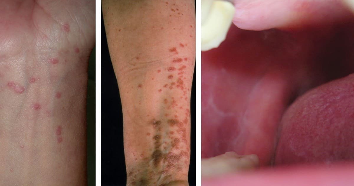 LIQUEN PLANO ORAL