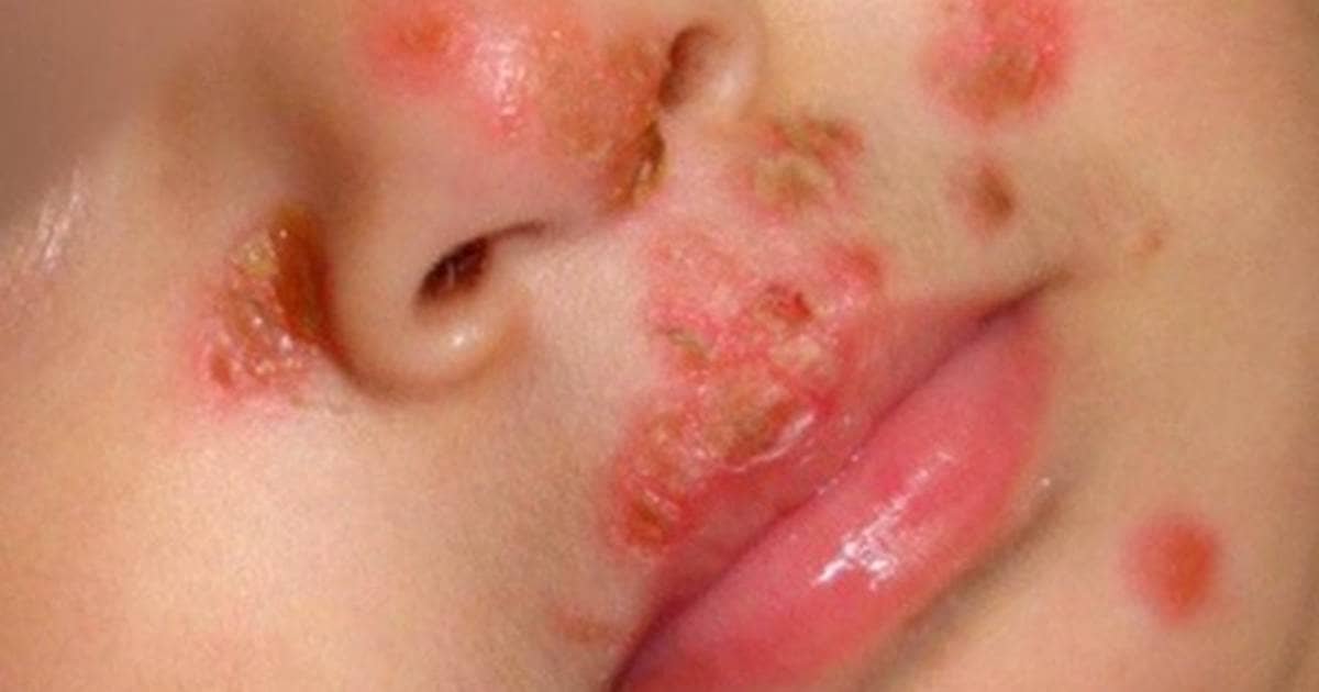 IMPETIGO EN NIÑOS