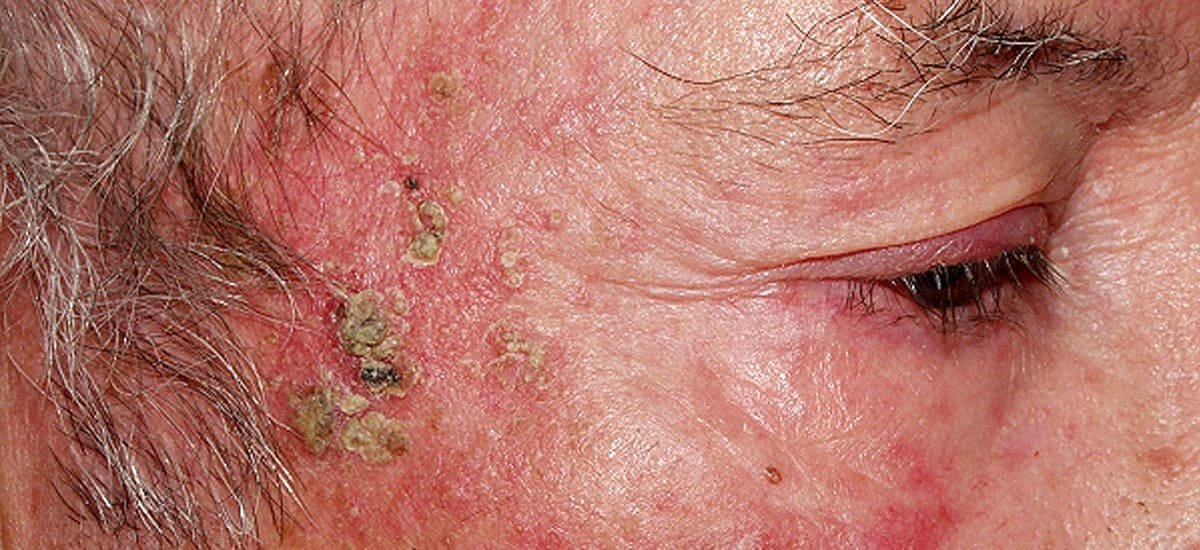 QUERATOSIS ACTINICAS