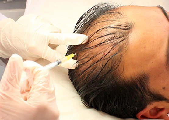 Mesoterapia Facial y Capilar